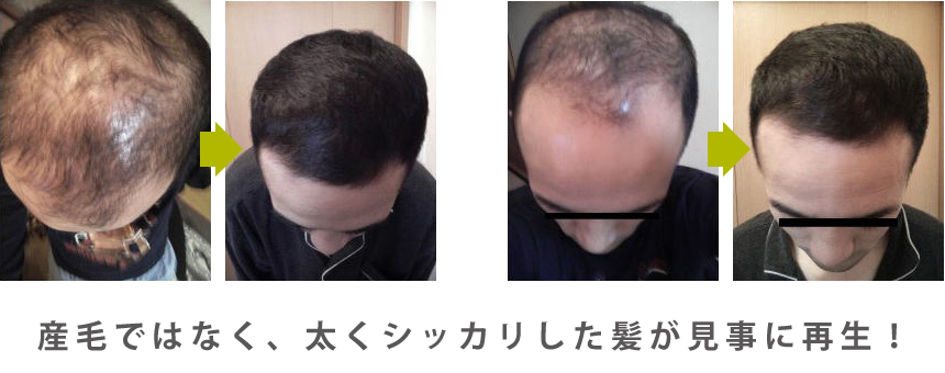 産毛ではなく、太くシッカリした髪が見事に再生!