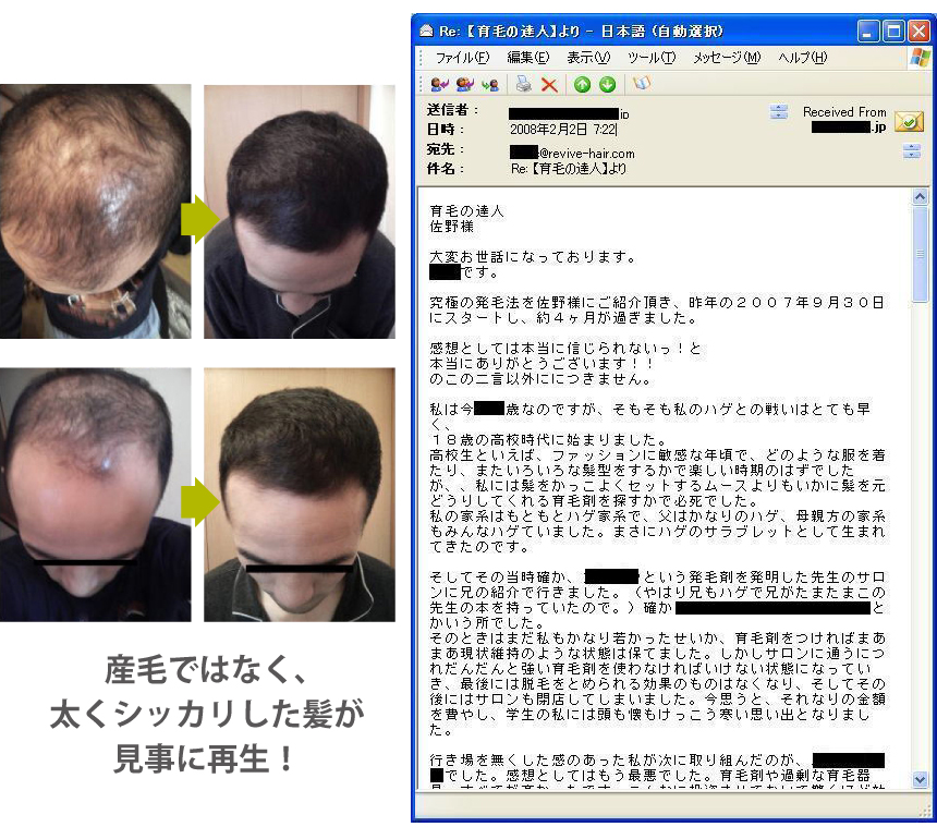 産毛ではなく、太くシッカリした髪が見事に再生!