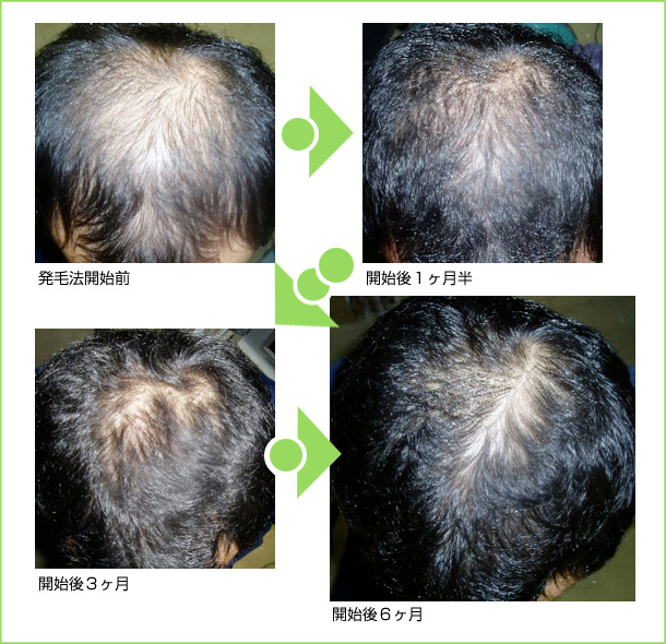 育毛の達人
